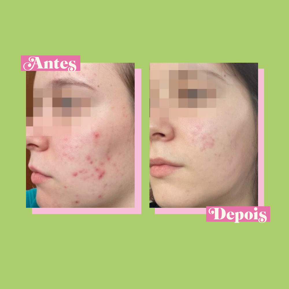 Kit Pele Mista e Oleosa